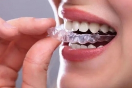 Braces 02