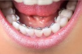 Braces 04